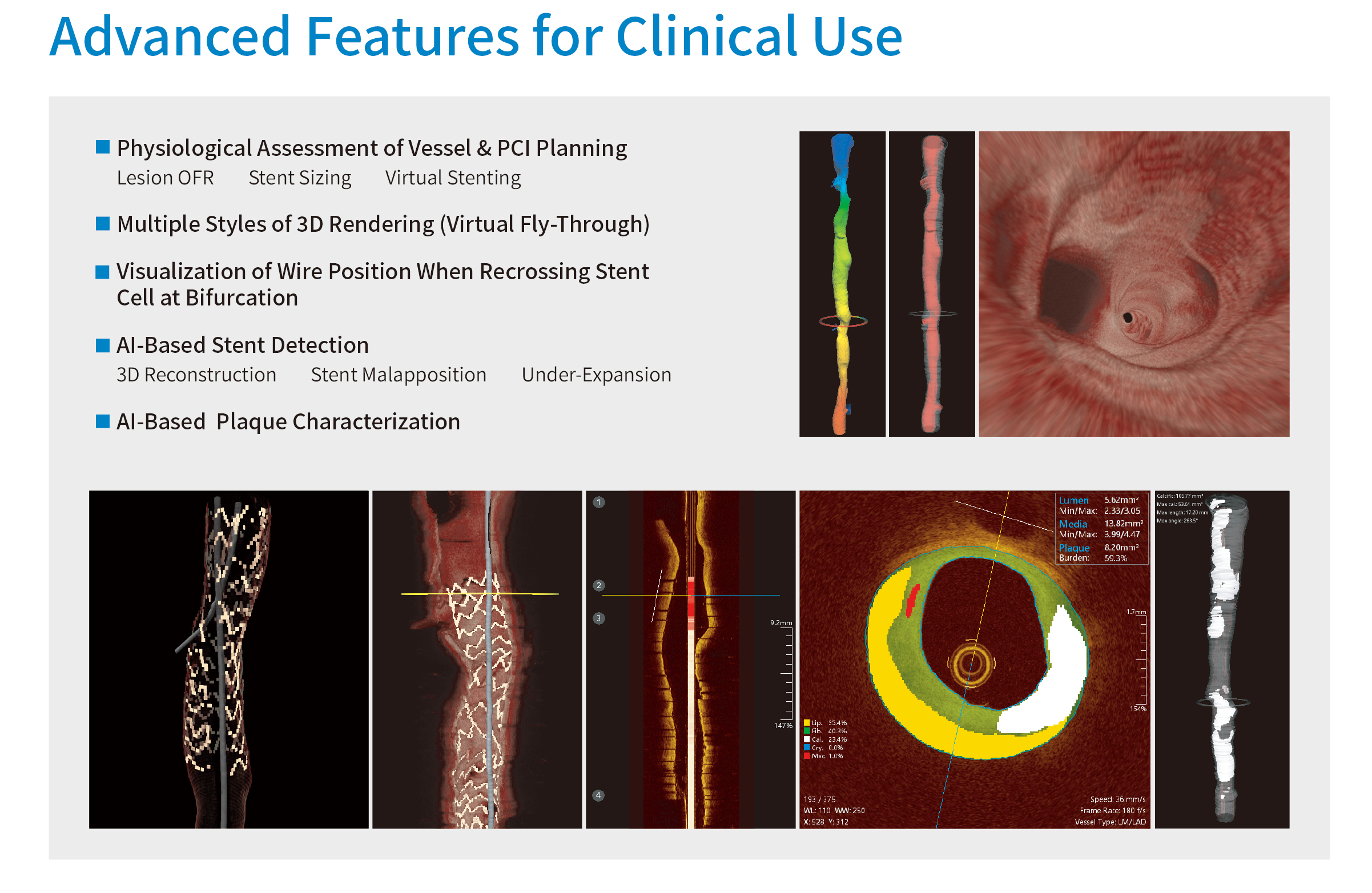 OFR (OCT based FFR) - PULSE - Leading the Precise Diagnosis and