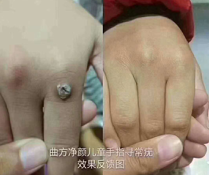 不激光不冷冻,签约修复各种问题肌肤.