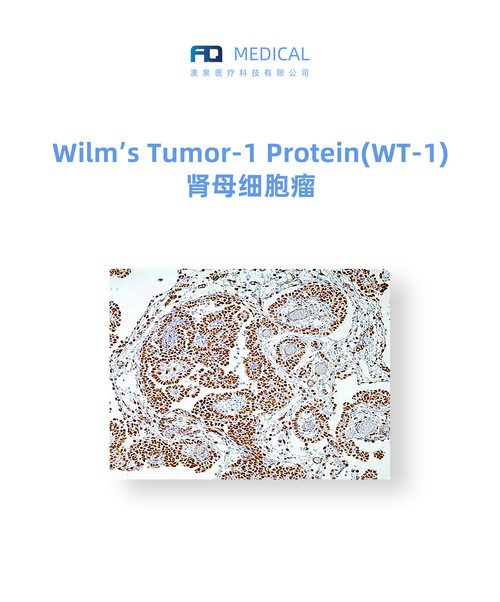 Wilm’s Tumor-1 Protein (WT-1)  肾母细胞瘤 (WT-1)