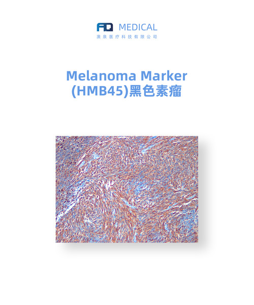 Melanoma Marker (HMB45)  黑色素瘤(HMB45)